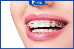 Niềng răng lâu nhất là bao nhiêu năm – 4 Tips rút ngắn
