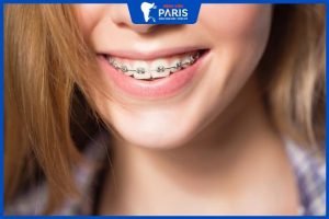 Niềng răng mắc cài kim loại có đau không, 4 tips giảm đau hiệu quả