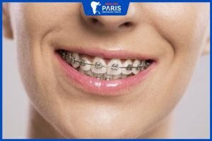 Niềng răng mắc cài kim loại mất bao lâu, 4 điều lưu ý sau niềng