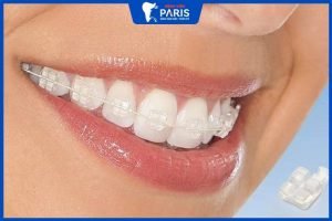 Niềng răng mắc cài sứ có đau không, 2 loại niềng mắc cài sứ