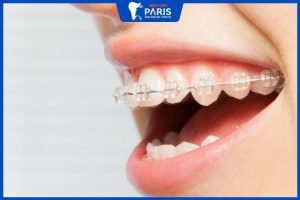 Niềng răng mắc cài sứ trong bao lâu, 5 Giai đoạn quan trọng
