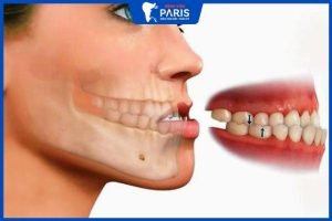 Niềng răng móm có đau không, 5 giai đoạn niềng răng cần biết