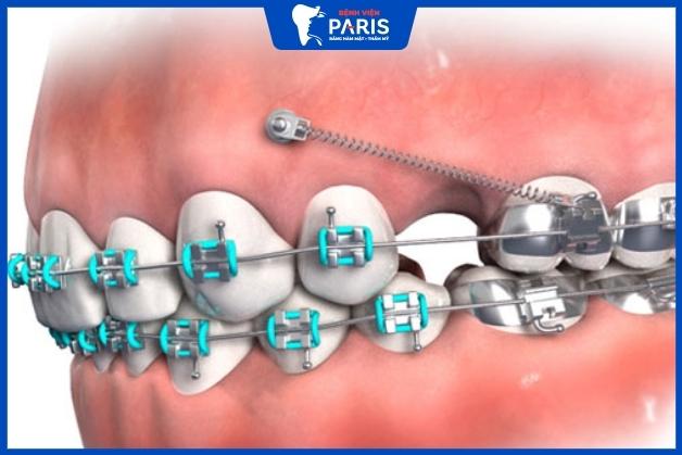 Niềng răng phải nhổ răng có ảnh hưởng gì không
