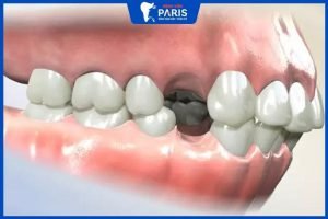 Niềng răng phải nhổ răng có ảnh hưởng gì không – Bác sĩ giải đáp