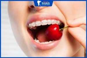 Niềng răng sau bao lâu thì ăn uống bình thường – Nên ăn gì khi niềng