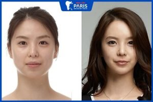 Phẫu thuật chỉnh hàm hô có nguy hiểm không – 6 lưu ý quan trọng