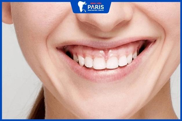 Phẫu thuật cười hở lợi bao lâu thì lành – 5 câu hỏi thường gặp