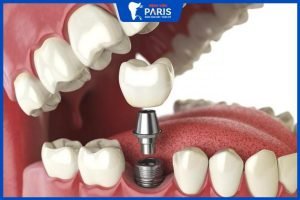 Răng cấm có trồng được không – 3 phương pháp phổ biến