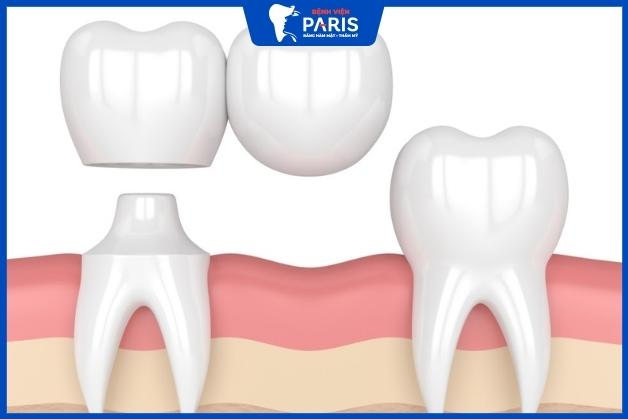 Răng sứ bắc cầu nhảy