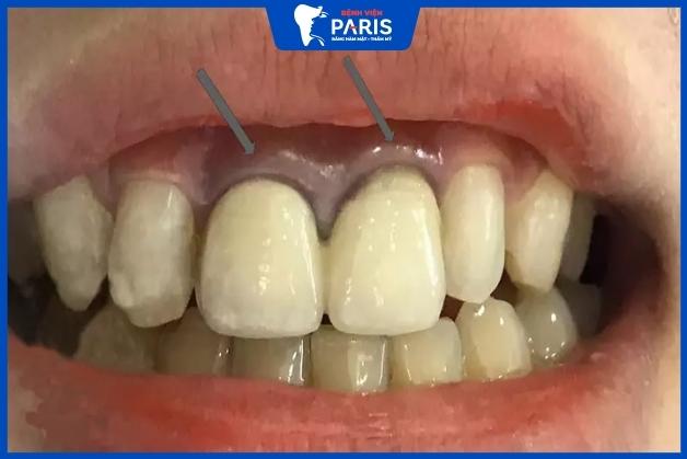 Hiện tượng đen viền nướu ở răng sứ kim loại