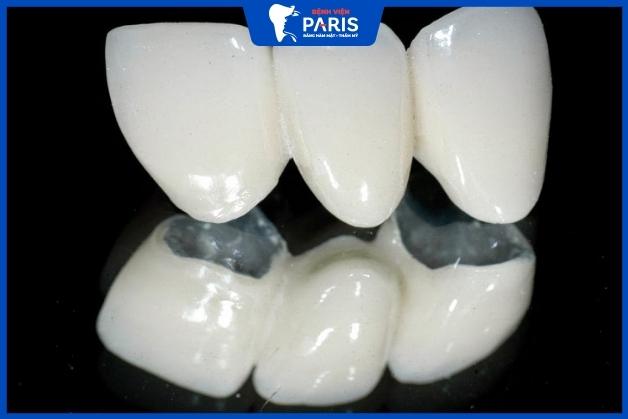 Răng sứ kim loại có tuổi thọ bao lâu