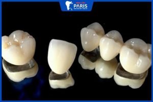 Răng sứ kim loại có tuổi thọ bao lâu – 4 mẹo tăng thời gian sử dụng