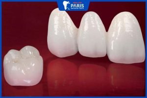 3 Loại răng sứ Lava bác sĩ nha khoa khuyên dùng? Giá bao nhiêu tiền?