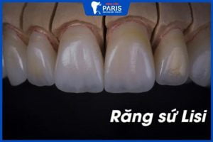 Răng sứ Lisi bao nhiêu tiền 1 cái – 5 Lưu ý quan trọng cần biết