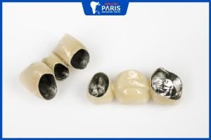 Răng sứ Titan có bị đen không? 7 Cách xử lý khi răng sứ Titan bị đen