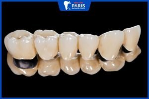 Răng sứ titan sử dụng được bao lâu – 4 yếu tố ảnh hưởng