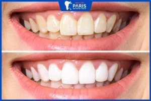 Tẩy trắng răng bao lâu thì lại tẩy lại được, dấu hiệu nên tẩy lại