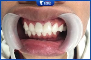 Tẩy trắng răng có bị ê buốt không – 5 tips giảm ê buốt hiệu quả