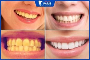 Tẩy trắng răng có bị vàng lại không, 7 lưu ý khi mới tẩy trắng răng
