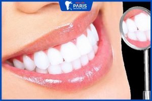 Tẩy trắng răng có hại răng không – 4 lưu ý khi tẩy trắng