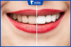 Tẩy trắng răng có nguy hiểm không, 4 chú ý tẩy trắng răng an toàn