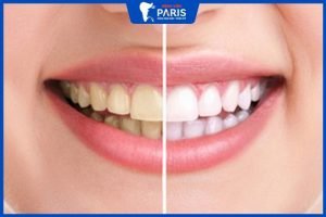 Tẩy trắng răng có tác dụng phụ không – cách hạn chế tác dụng phụ