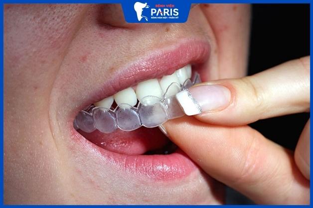 Phương pháp tẩy trắng răng bằng máng ngậm