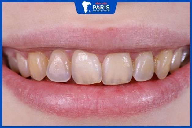 Tẩy trắng răng nhiều có thể gây ra tác hại gì?
