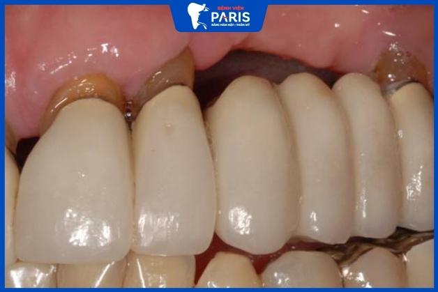 Tình trạng tiêu xương sau khi bắc cầu răng sứ