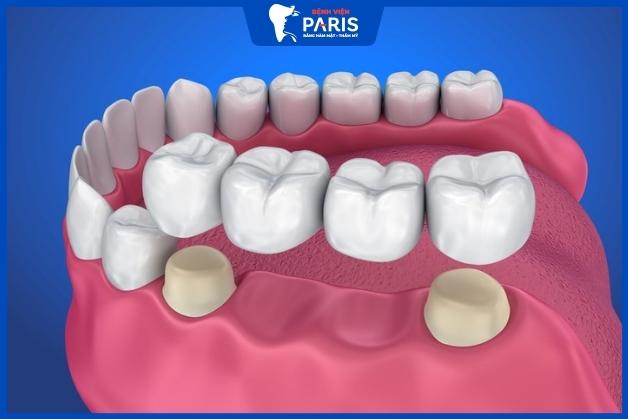 Trồng răng bắc cầu có tốt không, bền không