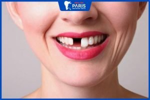 Trồng răng cửa có đau không – Nên áp dụng phương pháp nào
