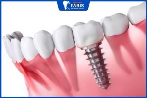 Trồng răng giả có bị hôi miệng không – 3 Nguyên nhân gây hôi miệng