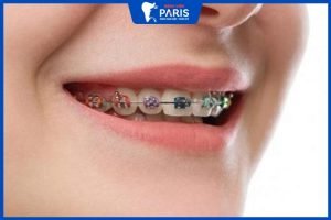 Trồng răng giả có niềng được không – Những điều cần lưu ý