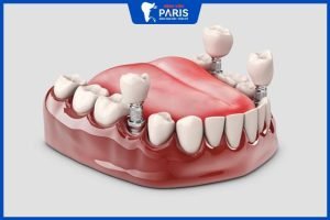 Trồng răng Implant bao lâu thì ăn được, nên và không nên ăn gì?