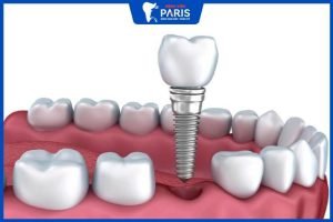 Trồng răng Implant bao lâu thì lành – 6 yếu tố tác động