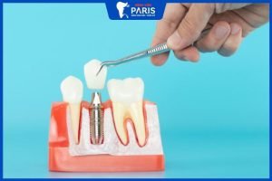 Trồng răng Implant bao lâu thì xong, cách rút ngắn thời gian làm