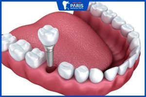 Trồng răng Implant có niềng được không, 5 Bước niềng răng