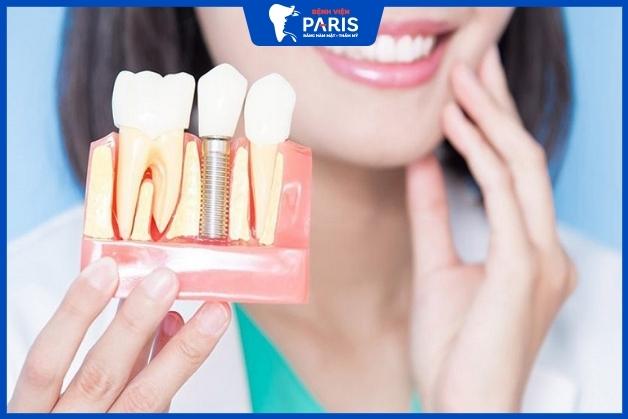 Trồng răng khểnh Implant