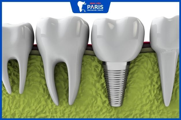 Ưu tiên trụ Implant tích hợp xương hàm nhanh