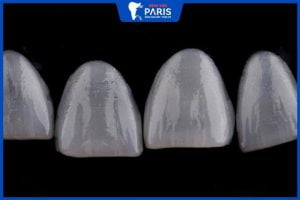 Veneer Ultrathin bao nhiêu tiền 1 cái – 4 điểm nhấn quan trọng
