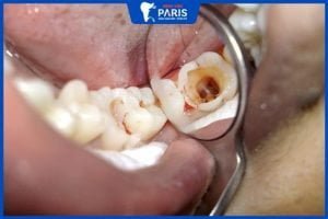 Bác sĩ tư vấn: Bị sâu răng có tẩy trắng răng được không?