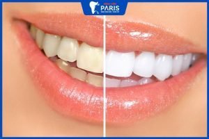 16 Phương pháp tẩy trắng răng an toàn hiệu quả