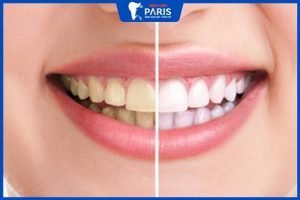 3 Tiêu chí chọn bệnh viện răng hàm mặt tẩy trắng răng chất lượng