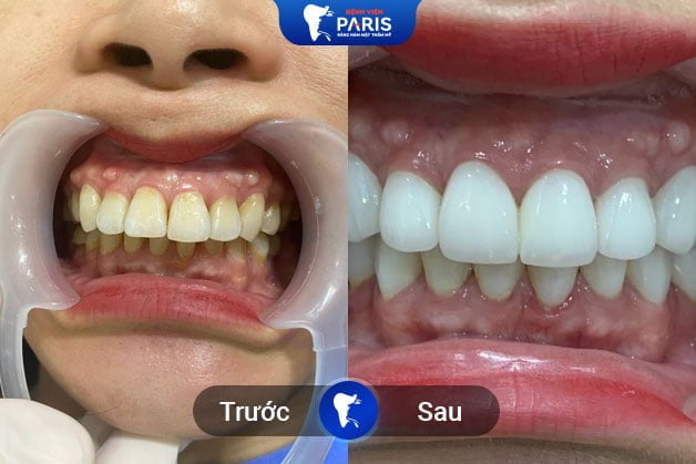 Hàm răng sau khi tẩy trắng