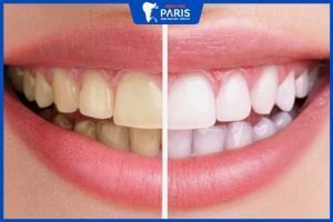 15 Cách tẩy trắng răng tại nhà hiệu quả và đơn giản
