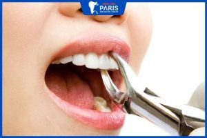 Hỏi – Đáp: Nhổ răng cửa có ảnh hưởng đến thần kinh không