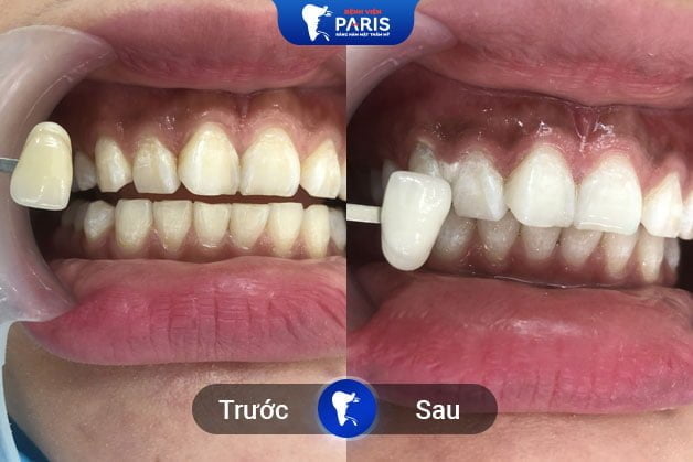 Kết quả của khách hàng trước và sau khi tẩy trắng răng tại Bệnh viện Paris