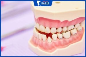 Khớp cắn ngược có niềng được không – 3 trường hợp cụ thể