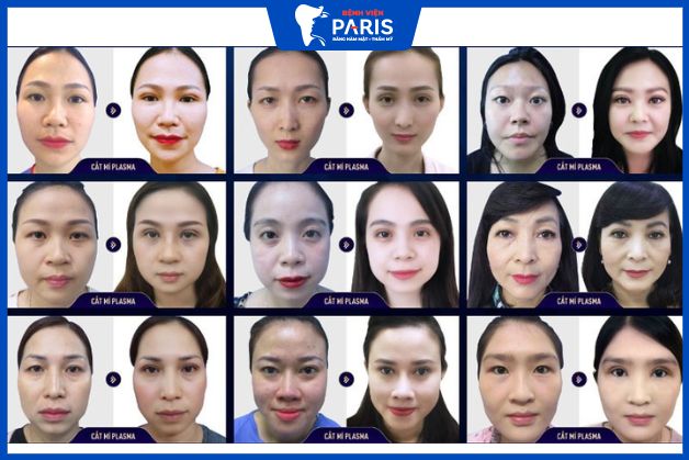 Rất nhiều trường hợp khuyết điểm mắt khó được khắc phục tại Paris