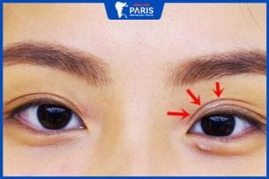 Mắt 3 mí nói lên điều gì? Cách khắc phục mắt ba mí thành hai mí